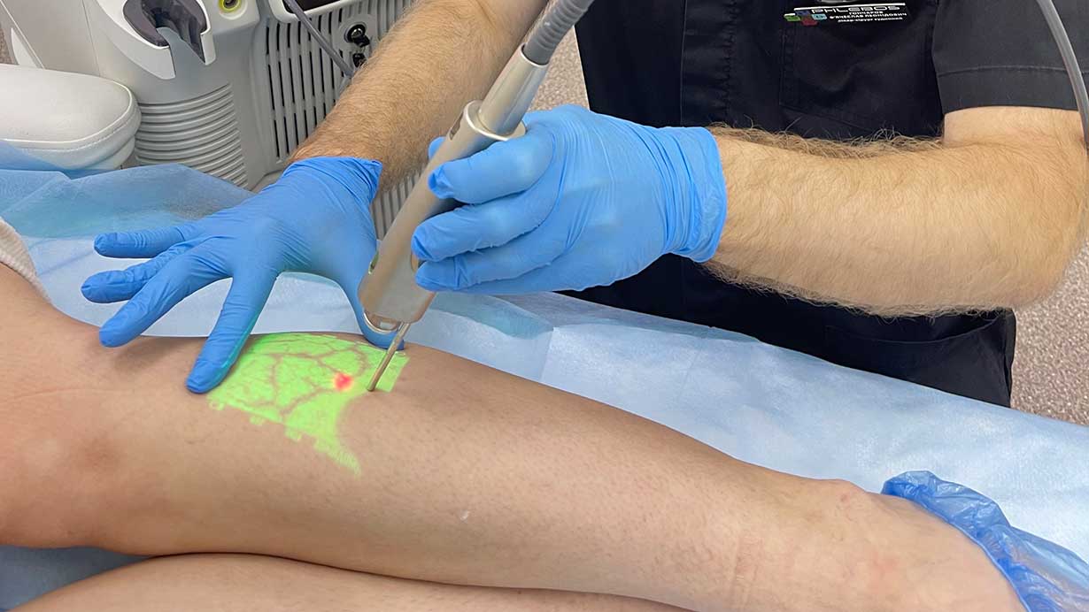 Sclerotherapy eliminates spider veins, vascular nets, and varicose symptoms without surgery