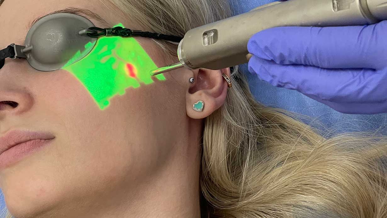 Лазерное удаление периорбитальных вен возле глаза у женщины во время процедуры