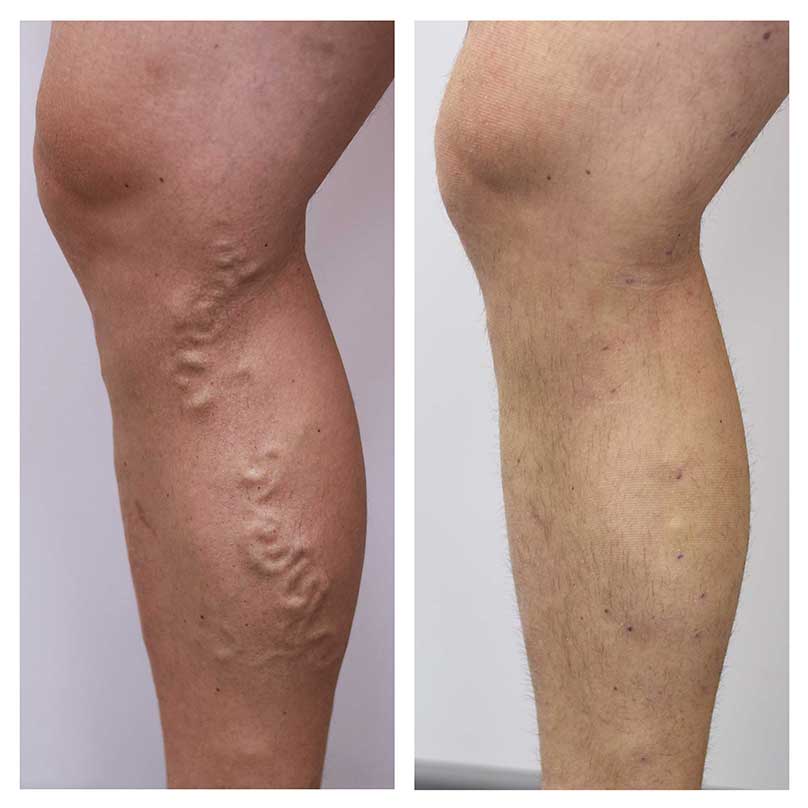 Endovenous Laser Coagulation EVLK photo of results