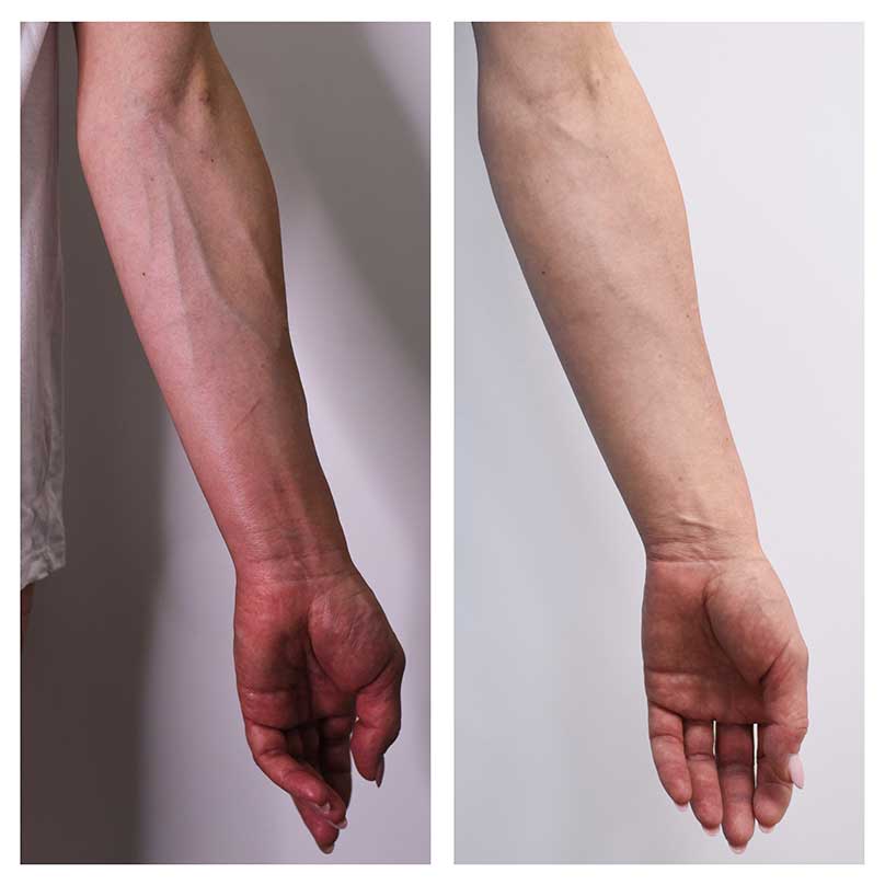 Preview: before and after laser vein treatment on arms
