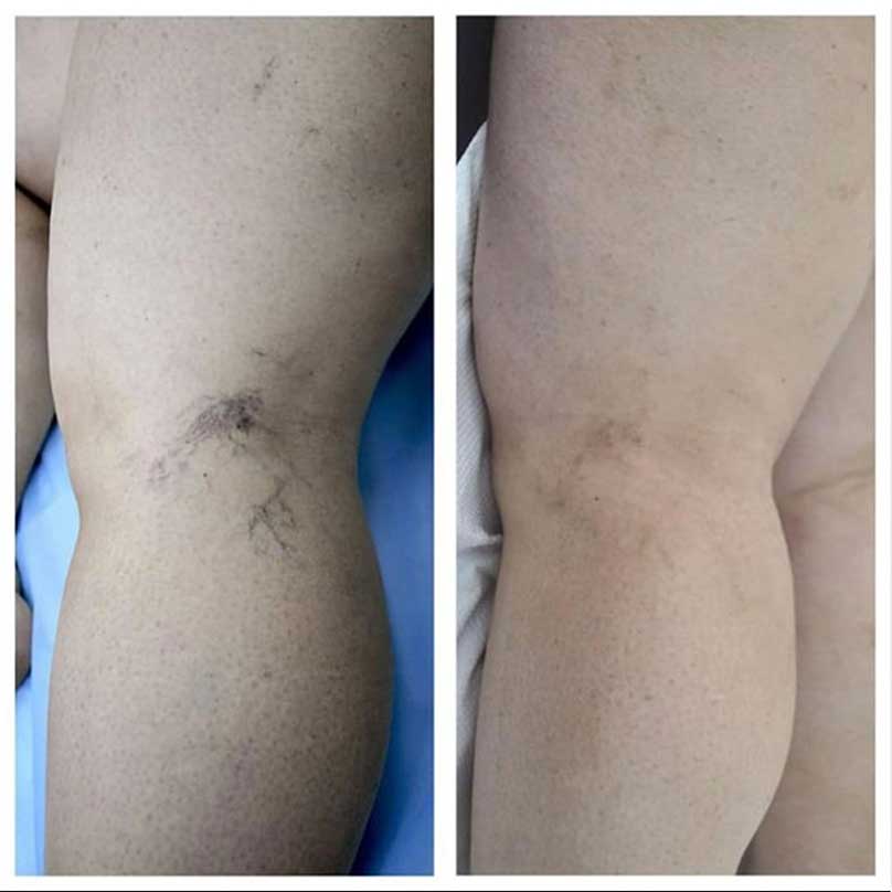 Varicose vein treatment with CLACS Phlebos