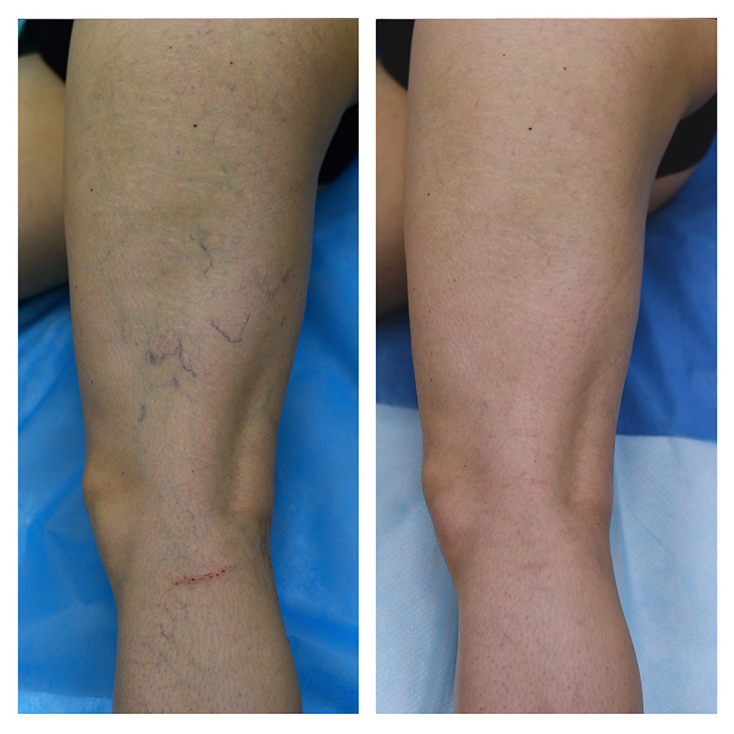 Before and after CLACS treatment for spider veins. Laser vein therapy by phlebologist Vyacheslav Honcharov (Phlebos Clinic, Kyiv). See more results and patient cases on Instagram @varicose_blog